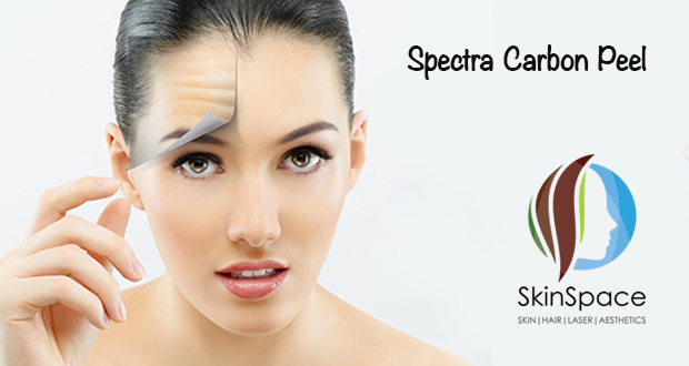 Spectra Laser Peel Treatment