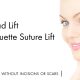 Silhouette Soft Thread Lift